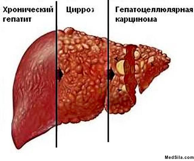 виды поражения печени